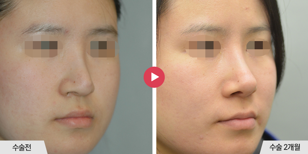 보형물이 비치는 경우