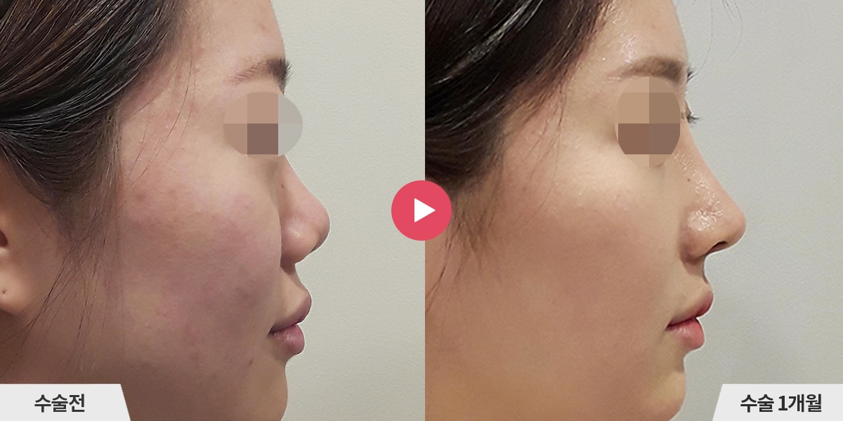 코성형+비순각교정+콧볼축소+귀족수술