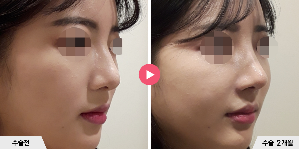 코성형+절골+콧볼축소+귀족수술