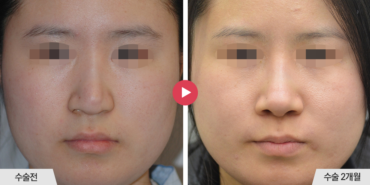 보형물이 비치는 경우