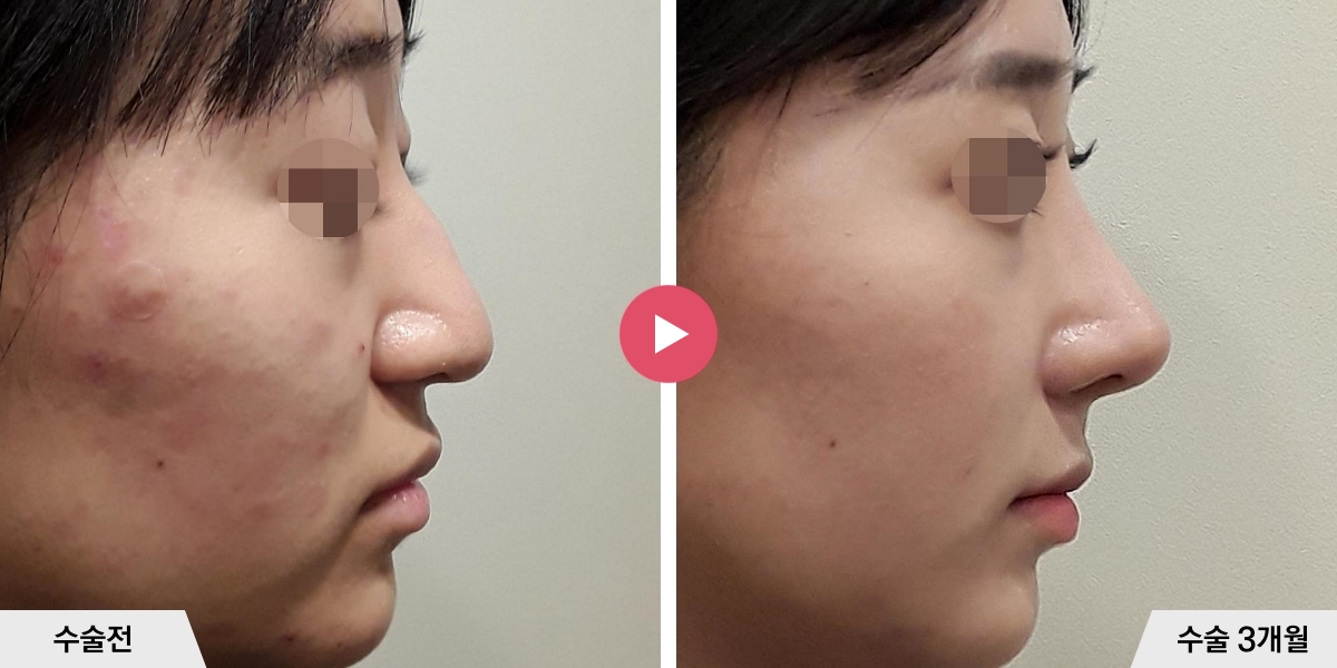 매부리코성형+절골+콧볼축소+귀족수술
