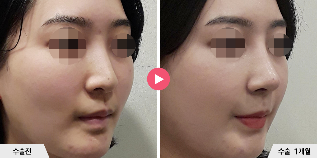 코성형+비순각교정+진피이식+콧볼축소+귀족수술