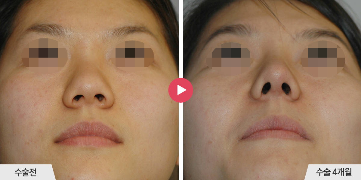 콧볼축소