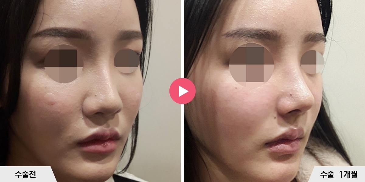 코재수술+비순각교정