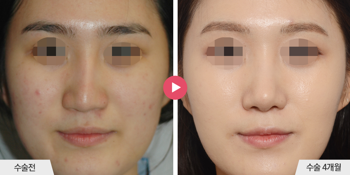 보형물이 삐뚤어진 경우