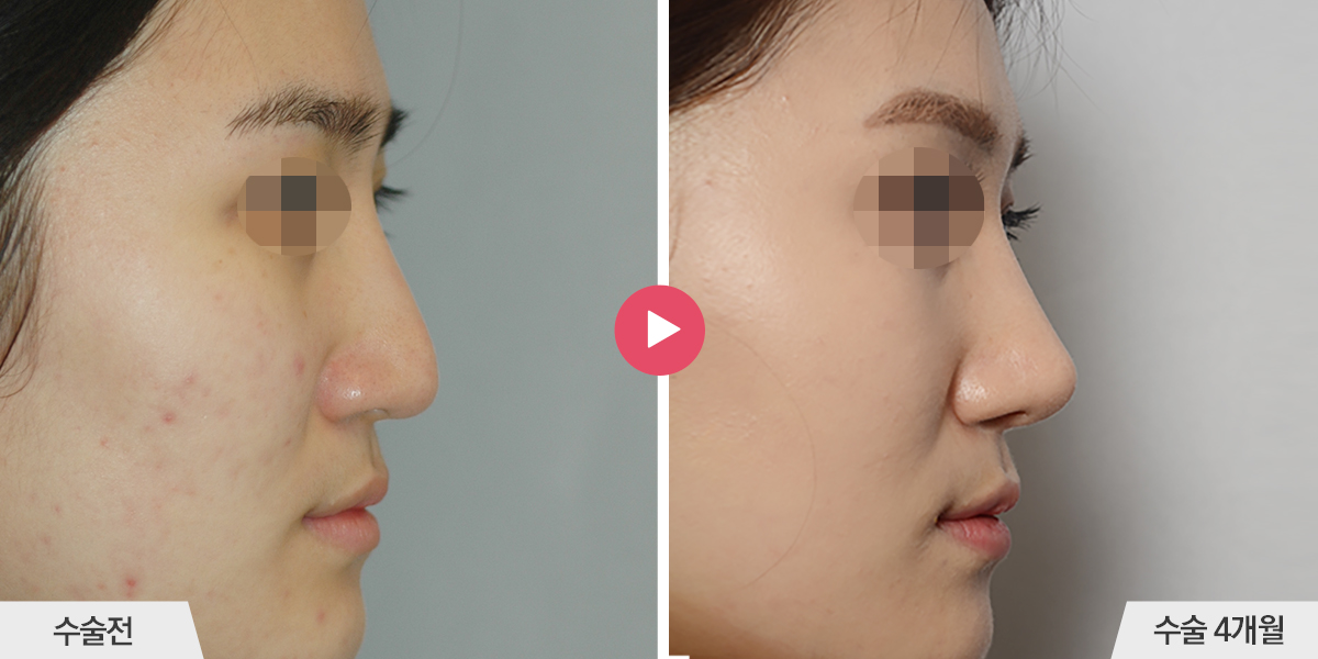 보형물이 삐뚤어진 경우