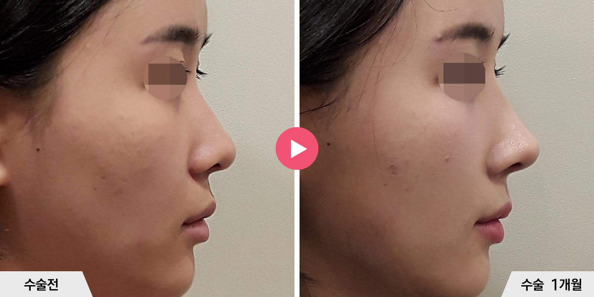 코성형+절골+비공내리기+진피이식