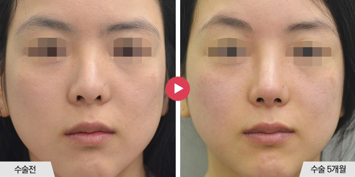 콧등이 매끄럽지 않거나 코끝과의 경계가 표시나는 경우