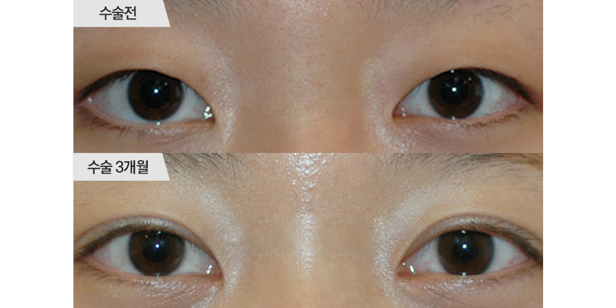 쌍꺼풀 수술 & 앞트임 수술