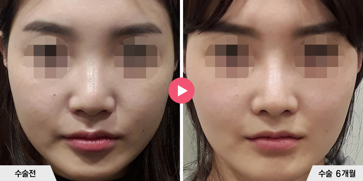 코성형+절골+비순각교정+진피이식