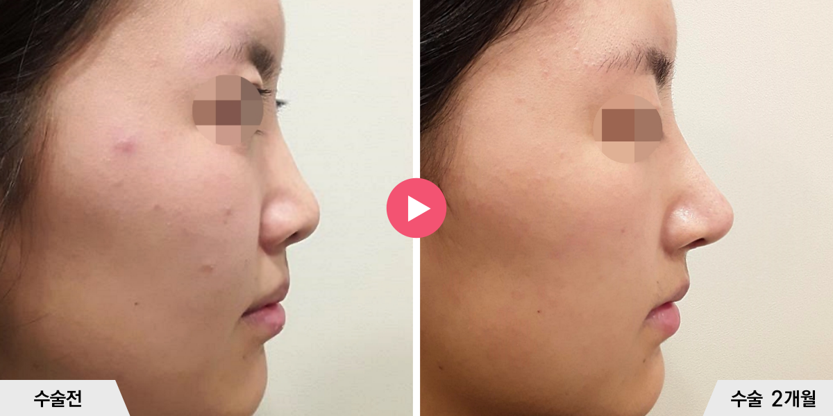 코성형+절골+진피이식+귀족수술