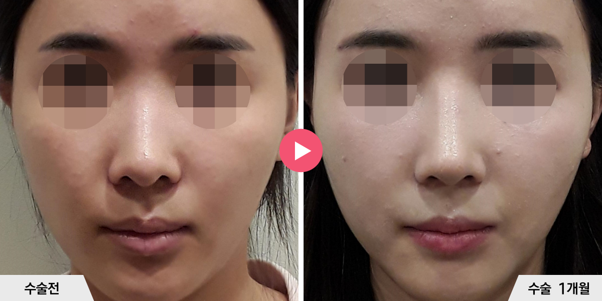 코성형+절골+비공내리기+진피이식