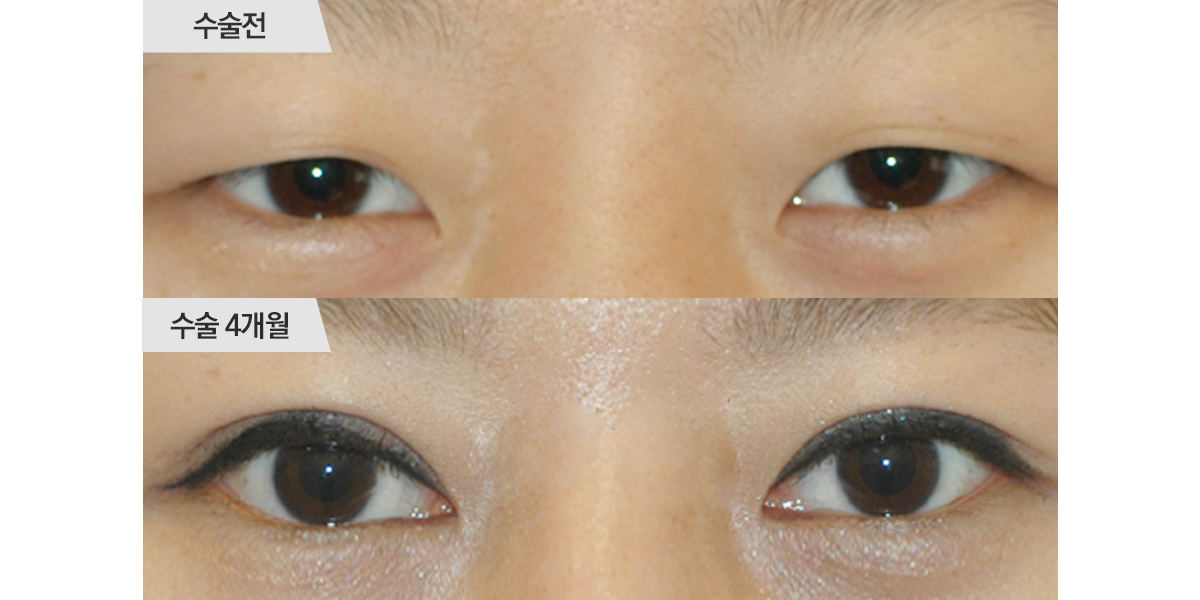 눈매교정 수술