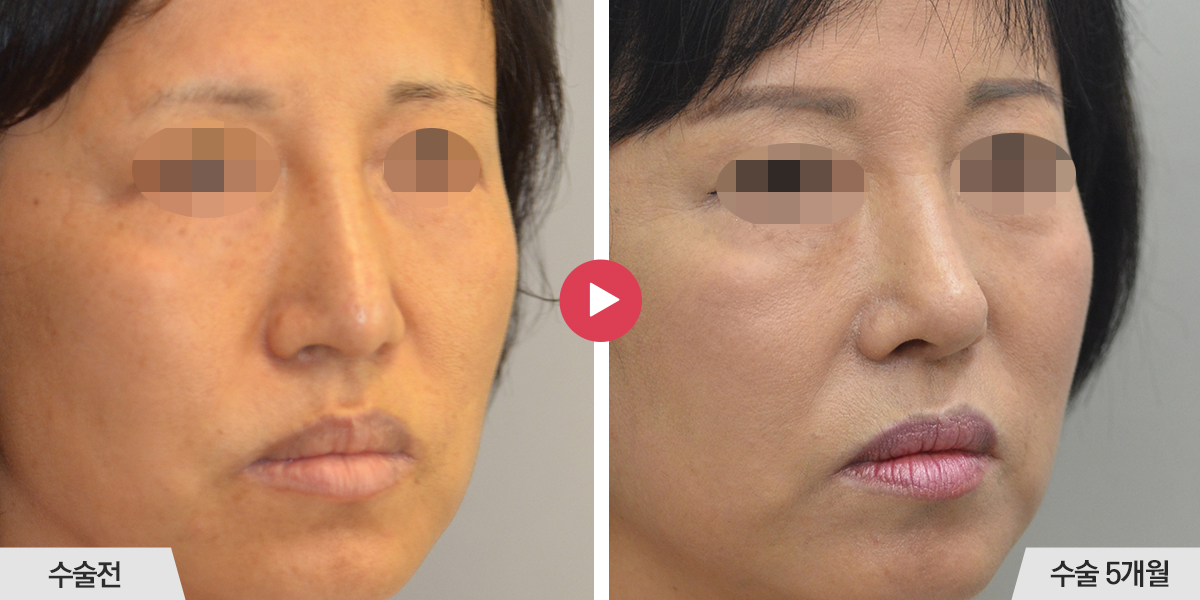 콧등이 너무 높은 경우