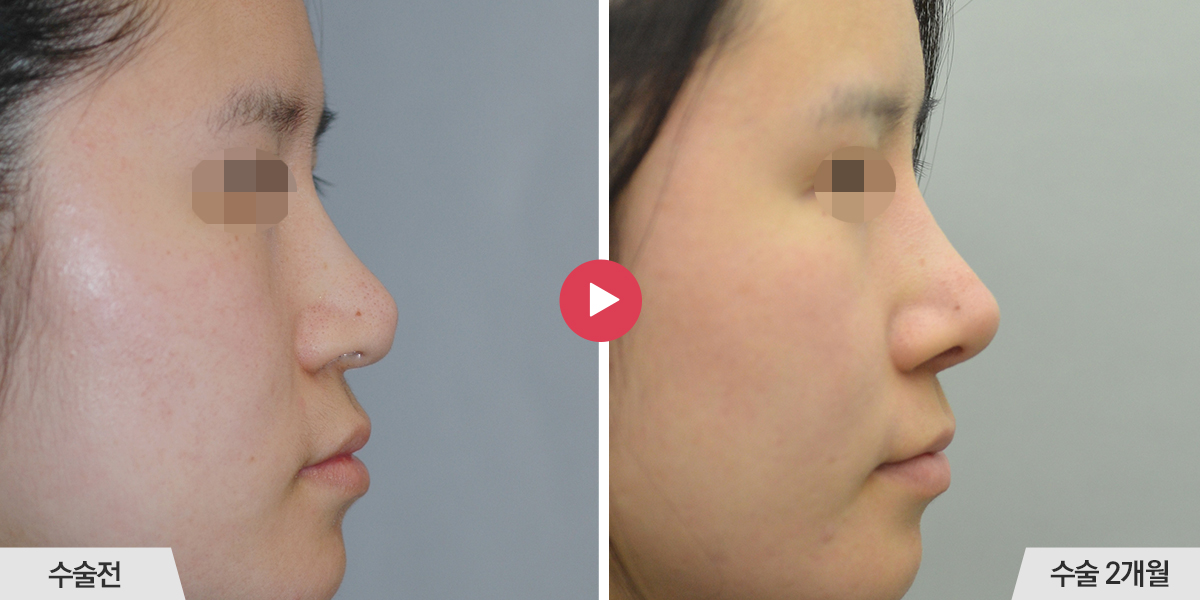 보형물이 비치는 경우