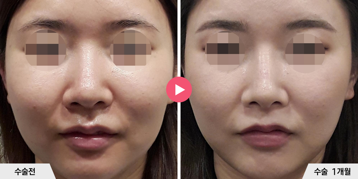 코성형+비순각교정+진피이식