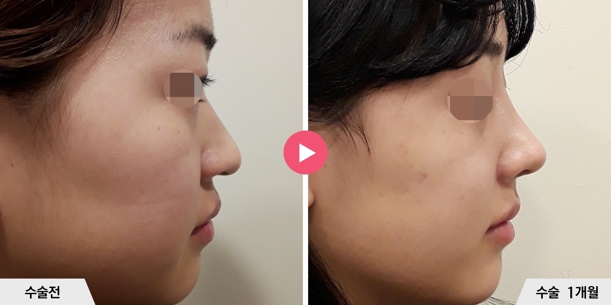 복코성형+비순각교정+콧볼축소+귀족수술