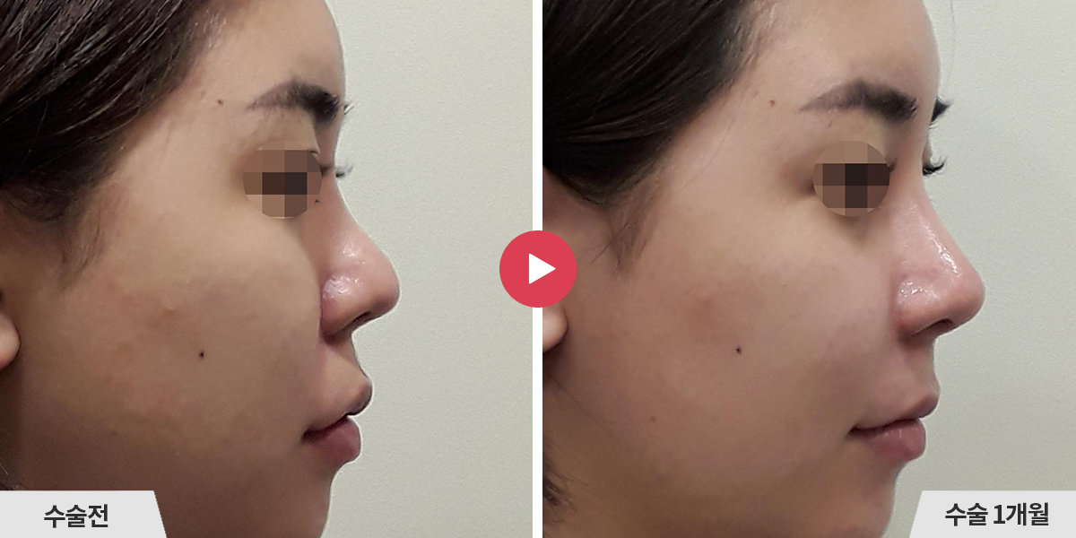 자가늑코재수술+콧볼축소+귀족수술
