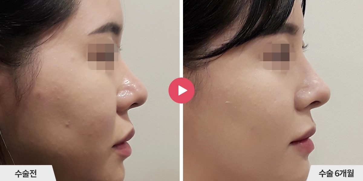 코성형+비순각교정