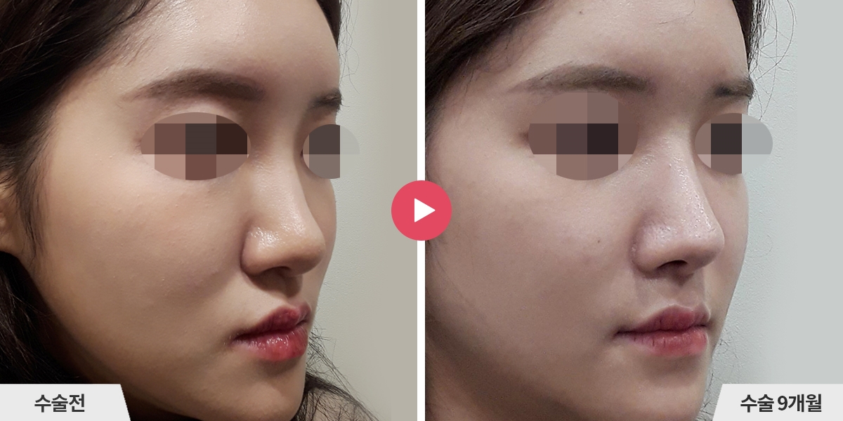 코성형+비순각교정+콧볼축소+귀족수술