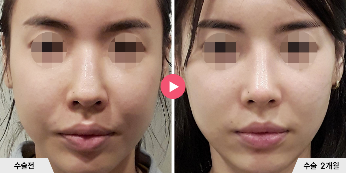 매부리코성형+절골+진피이식