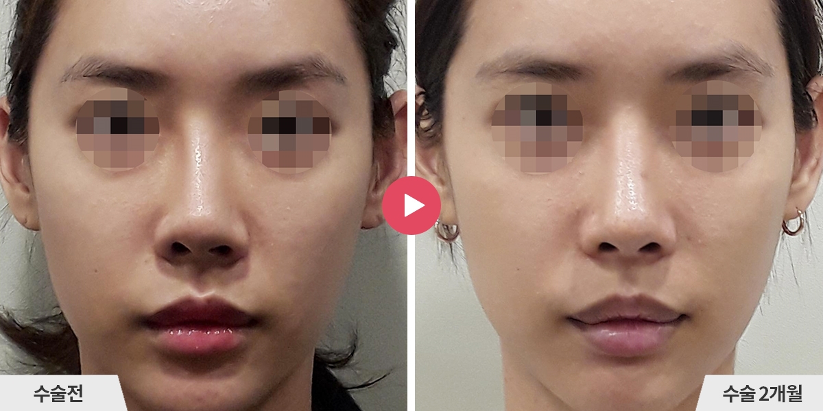 코재수술+비중격만곡증교정