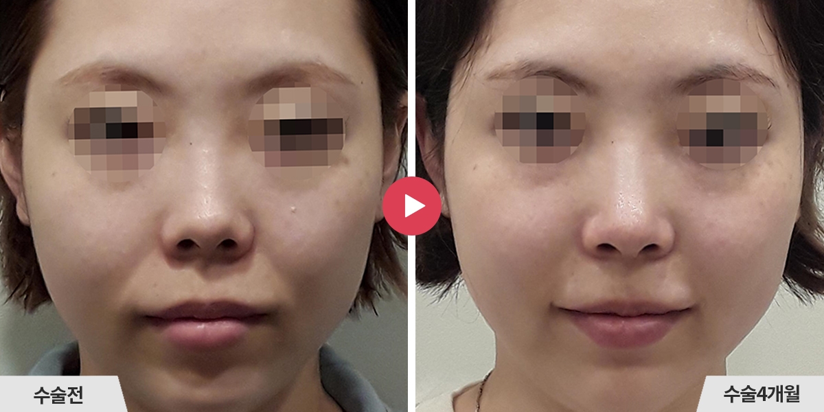 코재수술+비공내리기+진피이식