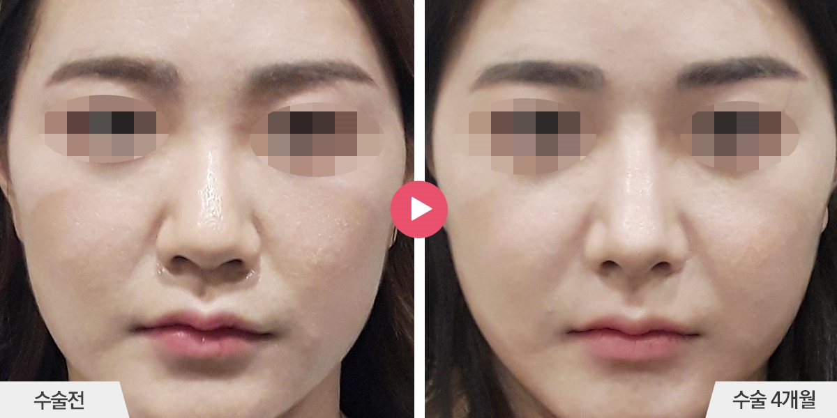 코성형+절골+콧볼축소+귀족수술