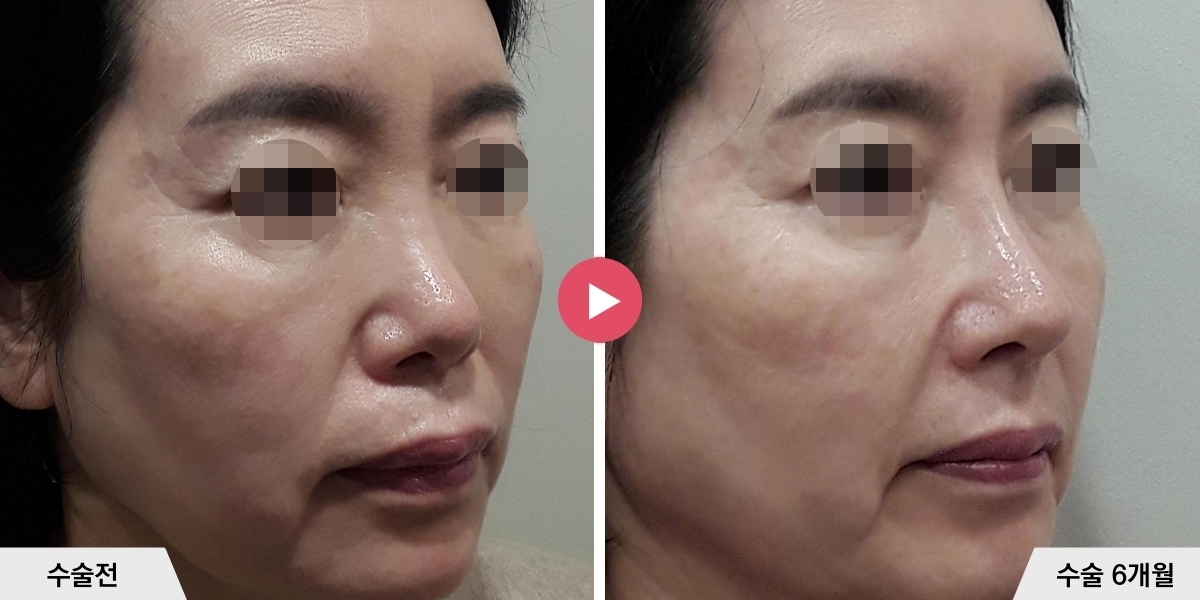 코성형+비순각교정+귀족수술