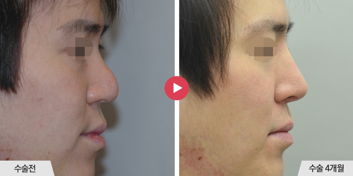 콧등이 매끄럽지 않거나 코끝과의 경계가 표시나는 경우