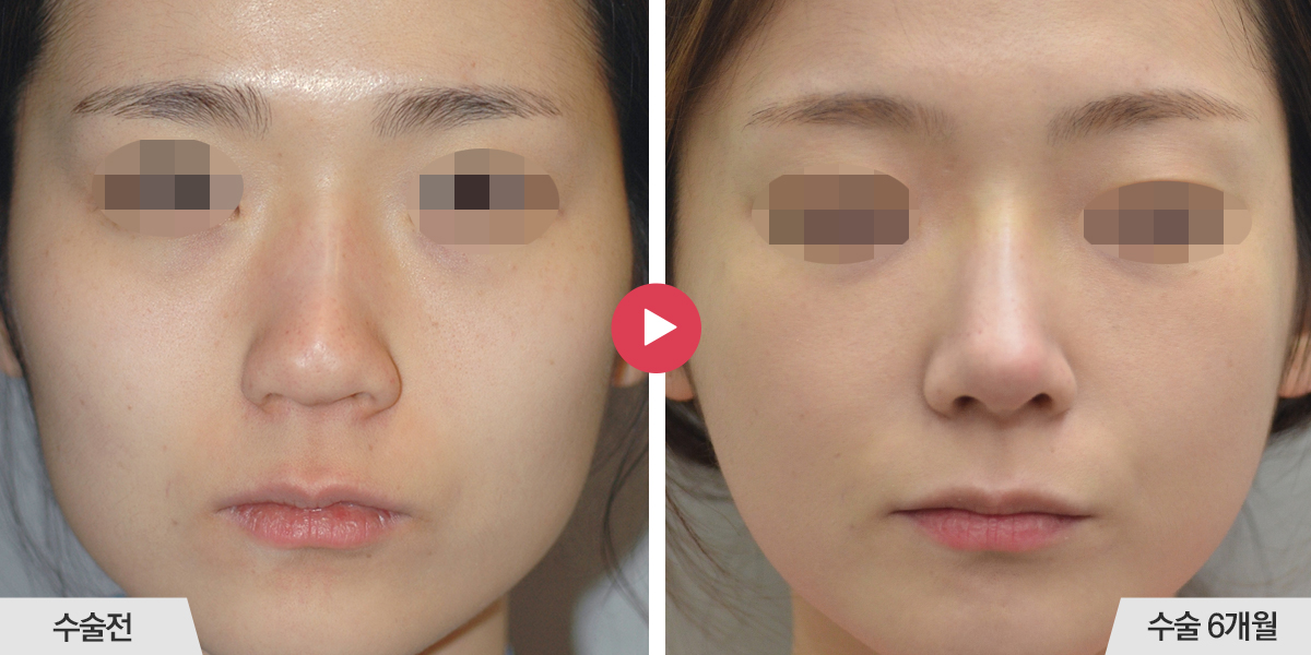 콧등이 넓거나 비대칭인 경우