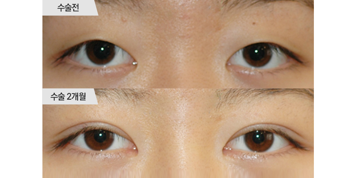 쌍꺼풀 수술, 매몰법 & 앞트임 수술