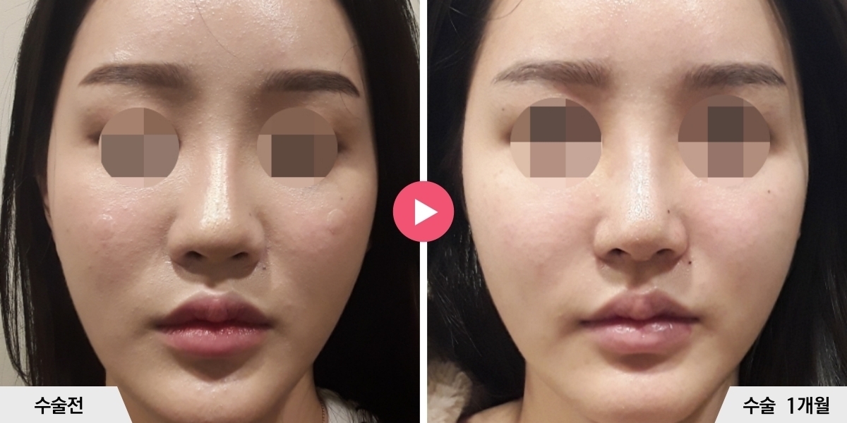 코재수술+비순각교정