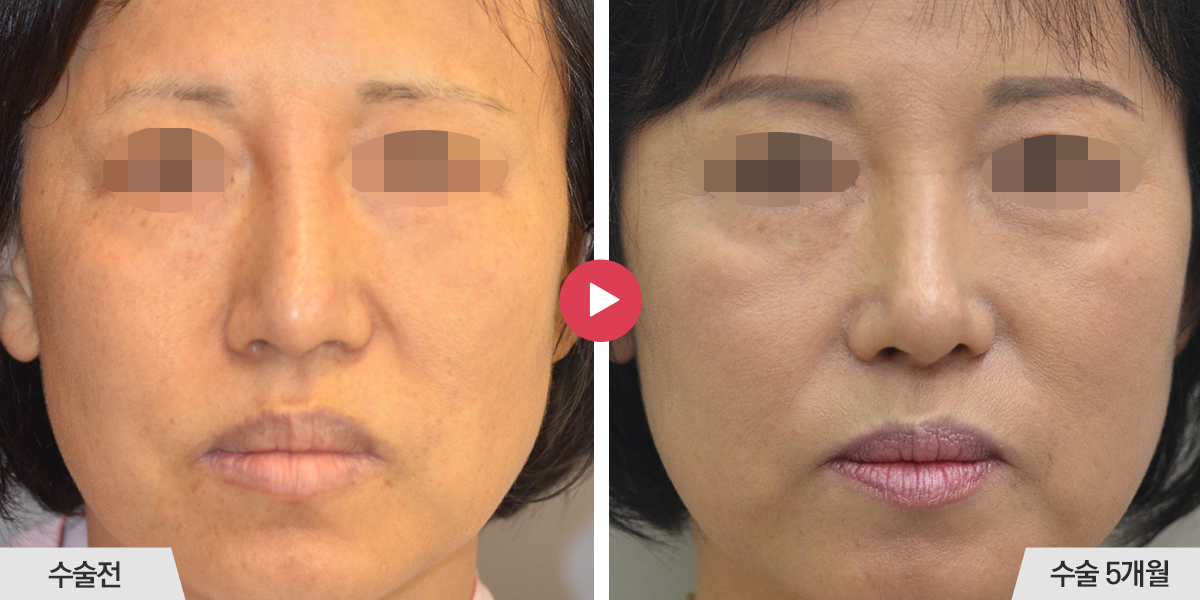 콧등이 너무 높은 경우