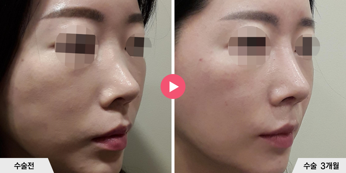 자가늑코재수술+절골+비순각교정+비공내리기+진피이식