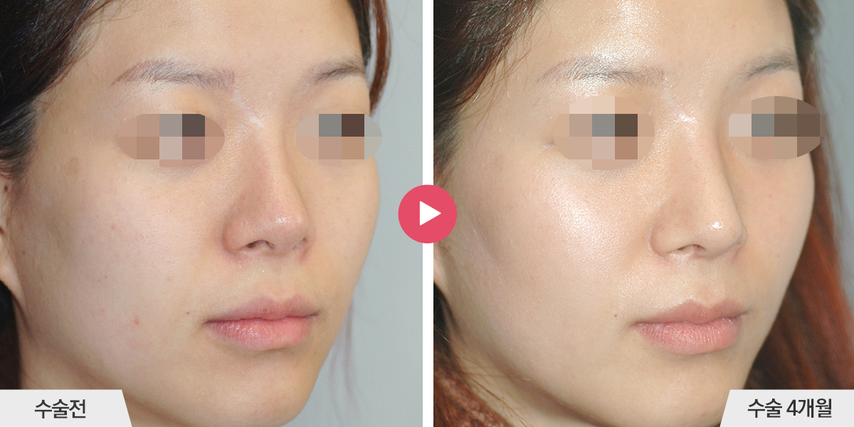 보형물이 삐뚤어진 경우