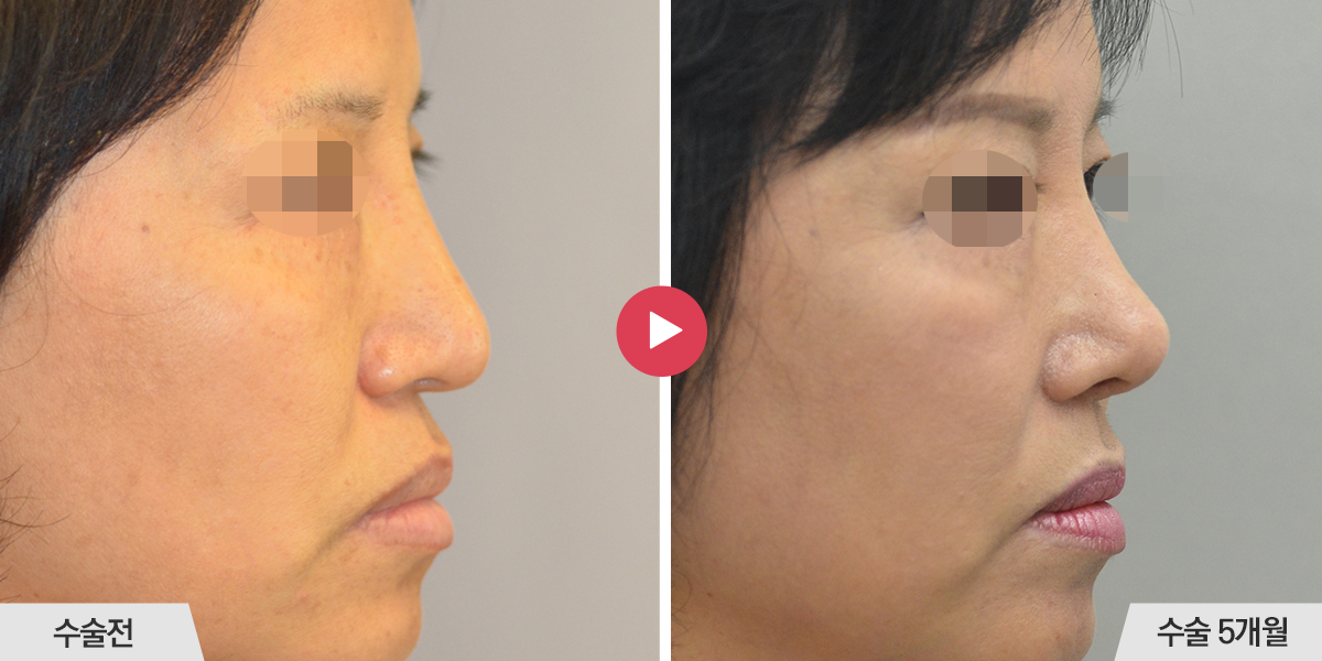 콧등이 너무 높은 경우