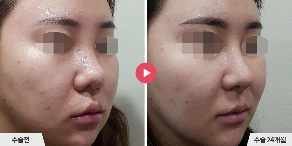 복코성형+비순각교정+콧볼축소+귀족수술