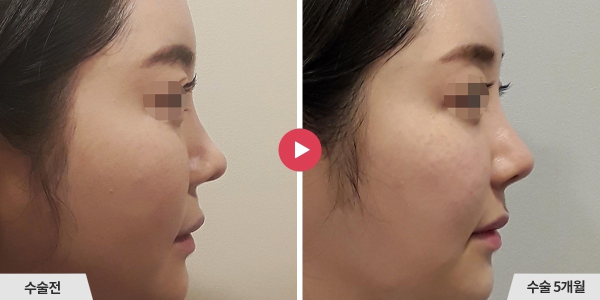 코재수술+비순각교정+진피이식