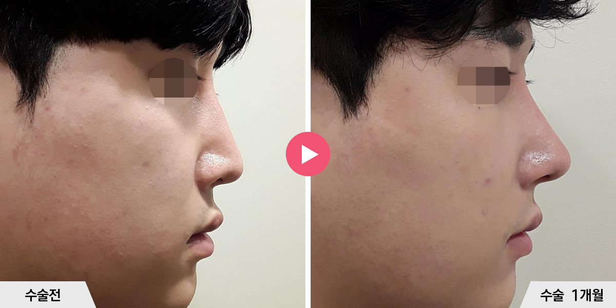 코재수술+비순각교정+진피이식