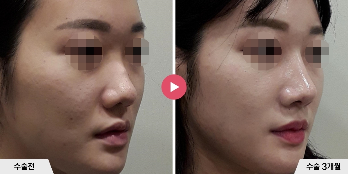 매부리코성형+절골