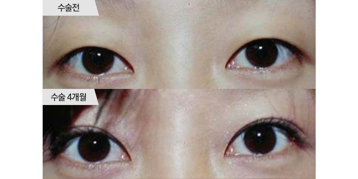 쌍꺼풀 수술, 매몰법