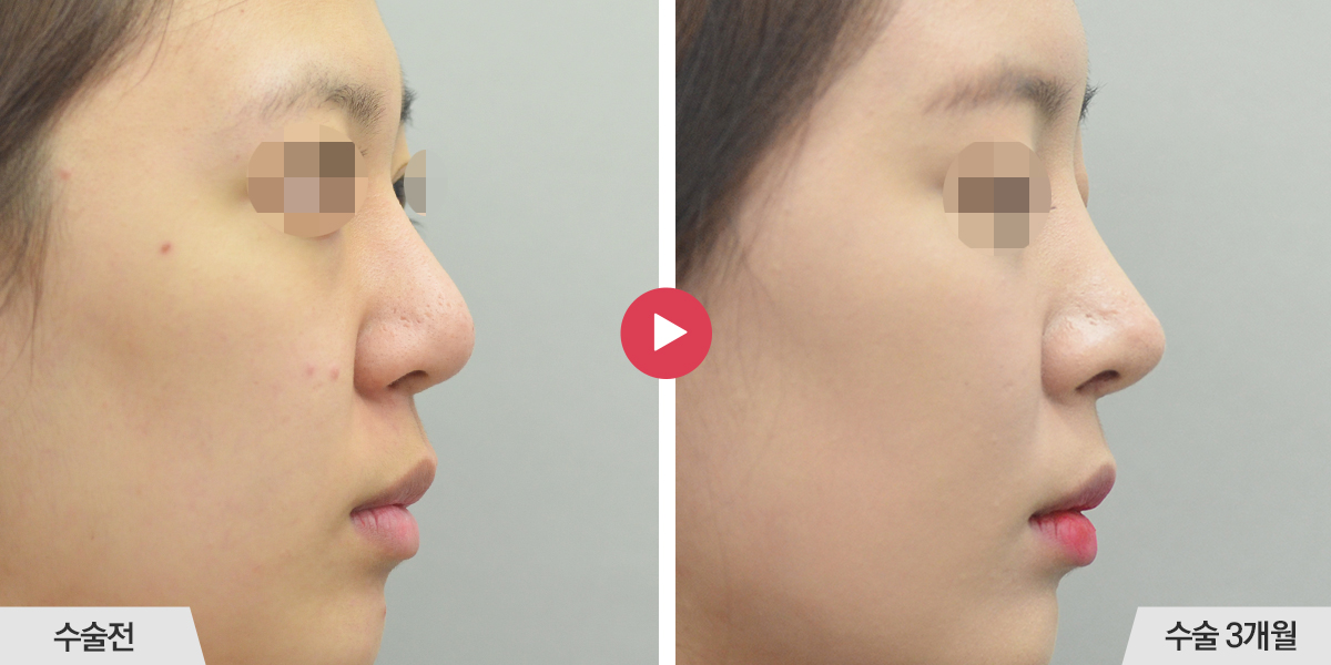 코끝이 뭉툭한 경우(복코 재수술)