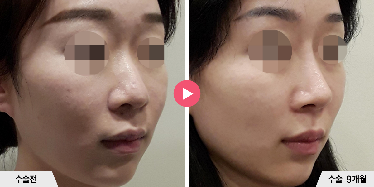 자가늑코성형+비순각교정+콧볼축소+귀족수술+비중격만곡증교정