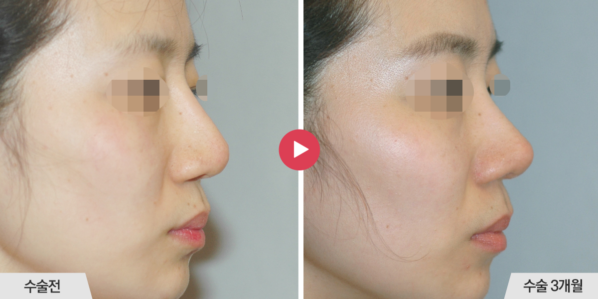 콧등의 폭이 좁은 경우
