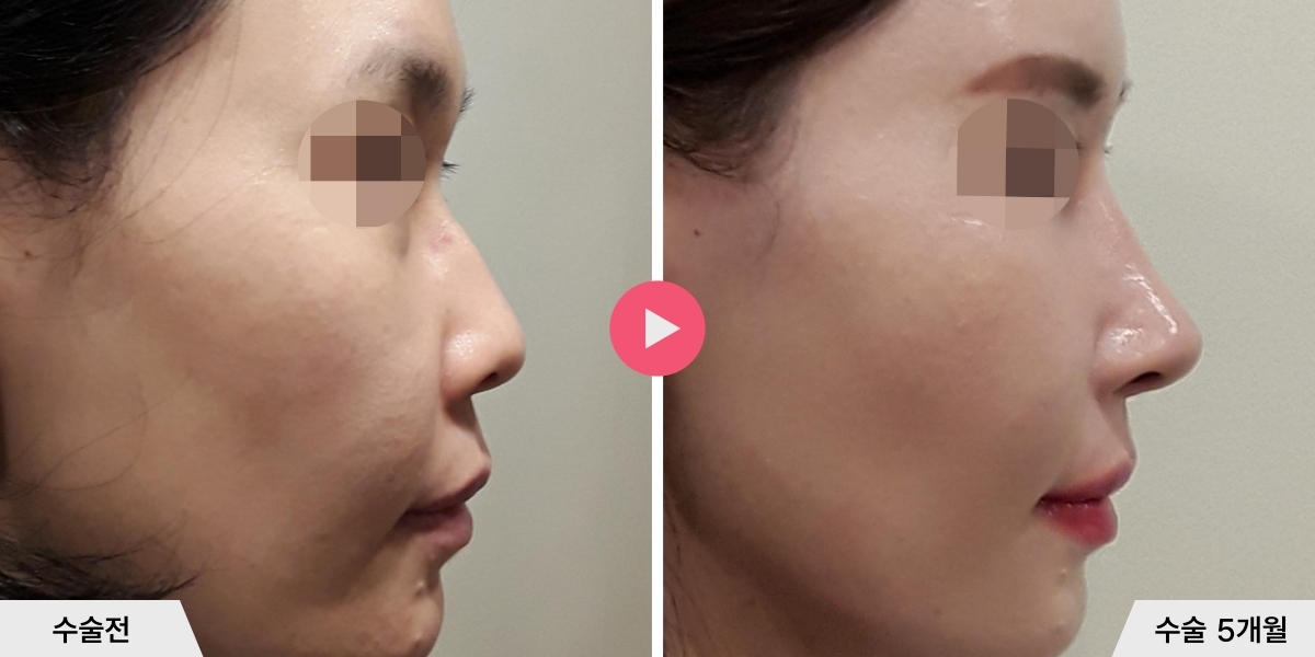매부리코성형+진피이식
