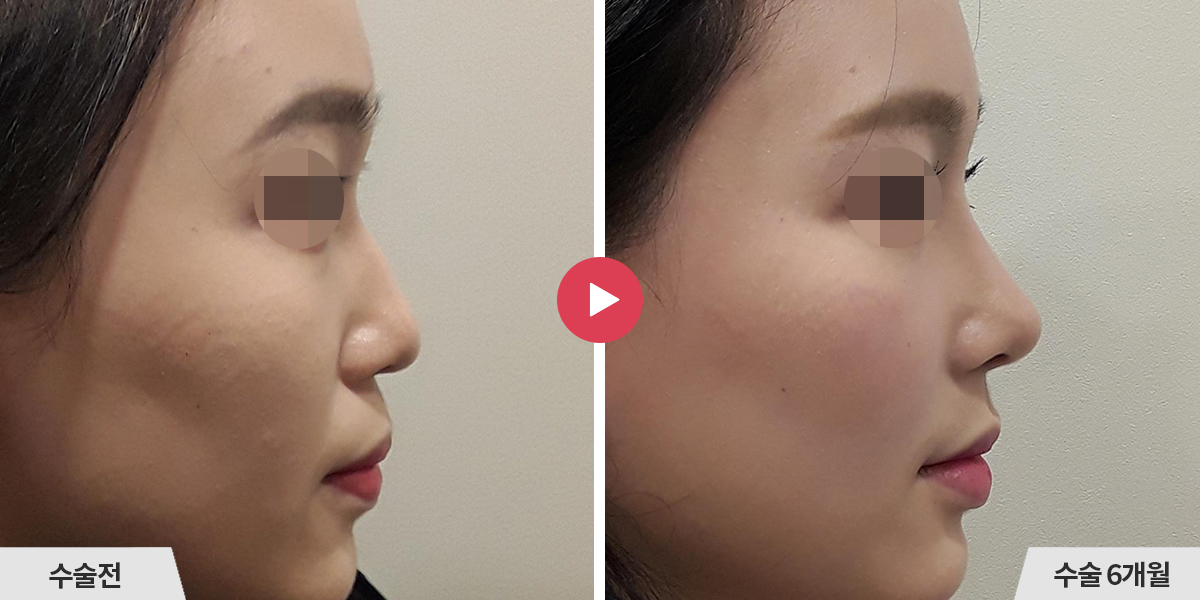 매부리코성형+비순각교정+진피이식+귀족수술