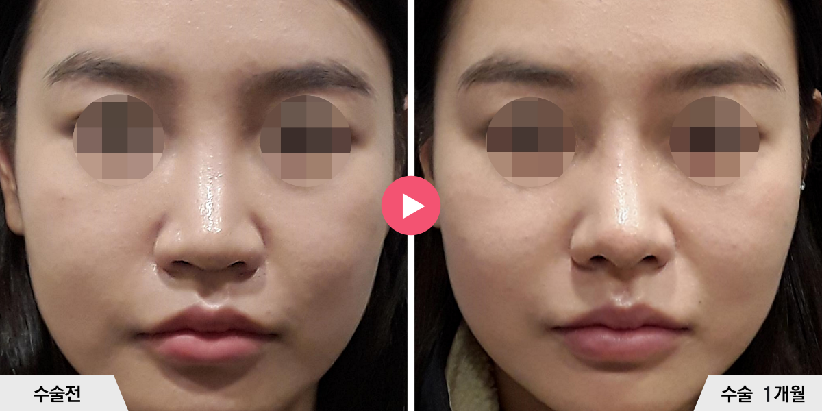 코성형+비순각교정+진피이식