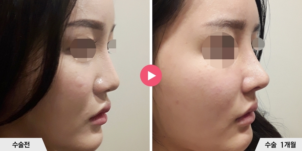 코재수술+비순각교정