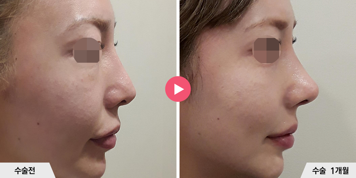 코재수술+절골+비공내리기+진피이식+귀족수술